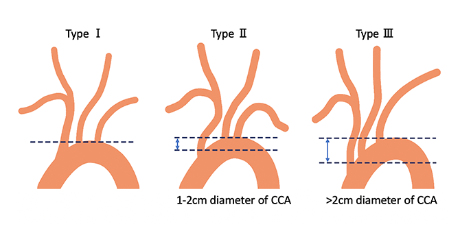 動脈硬化に伴う大動脈の蛇行・延長の程度の分類